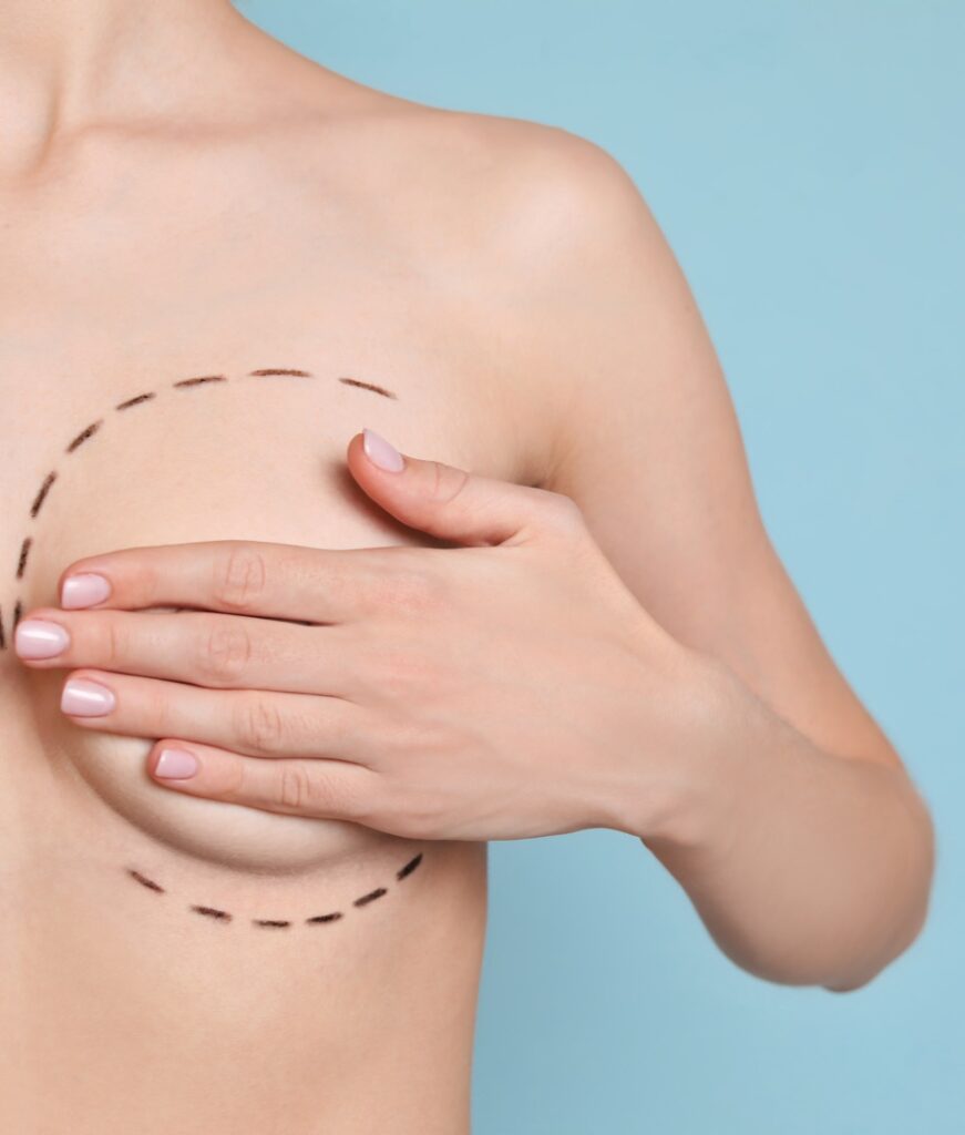 Young woman with marks on breast for cosmetic surgery operation against color background